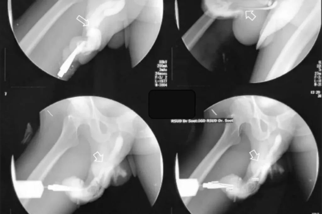 陰莖骨折會馬上發生劇痛，別怕去看醫生，否則將造成永久傷害