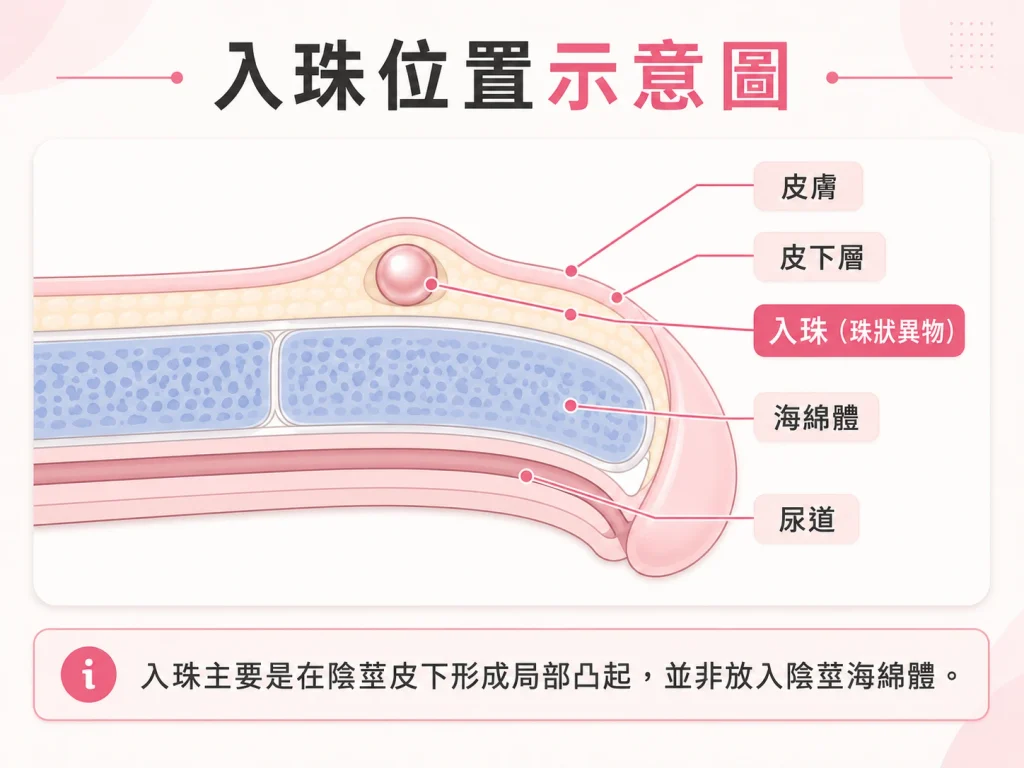 陰莖皮下入珠位置的簡化醫療示意圖